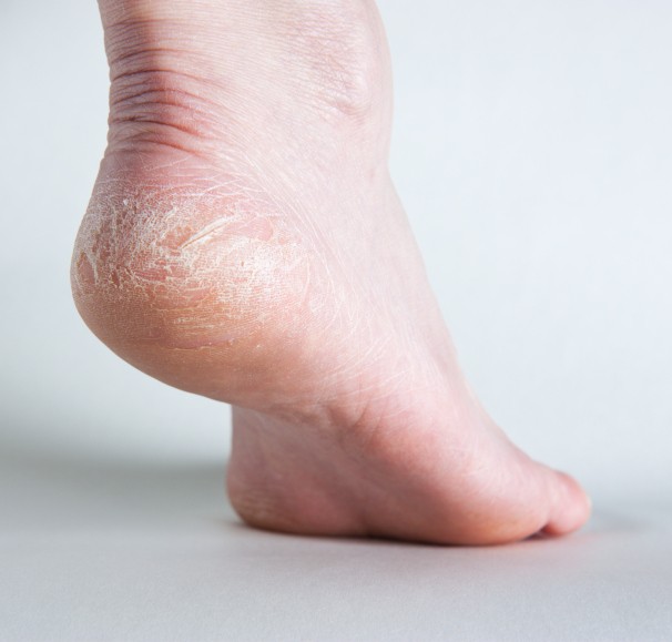 pés ressecados sem tratamento foot works aton serum concentrado